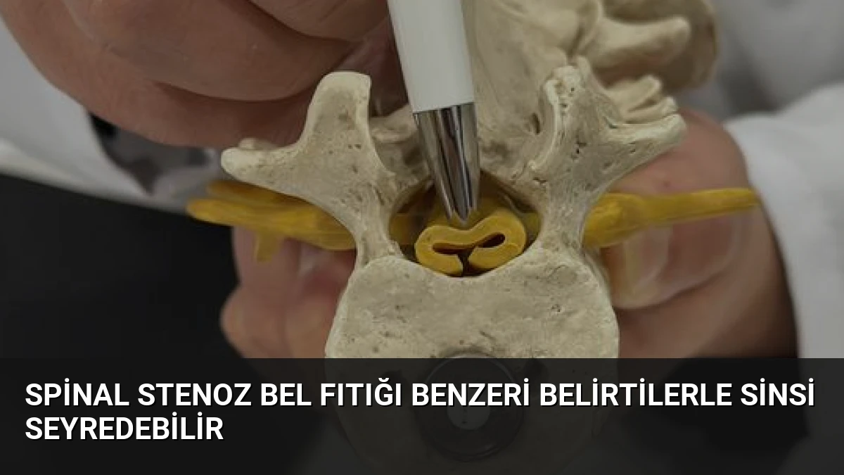 Spinal Stenoz Bel Fıtığı Benzeri Belirtilerle Sinsi Seyredebilir