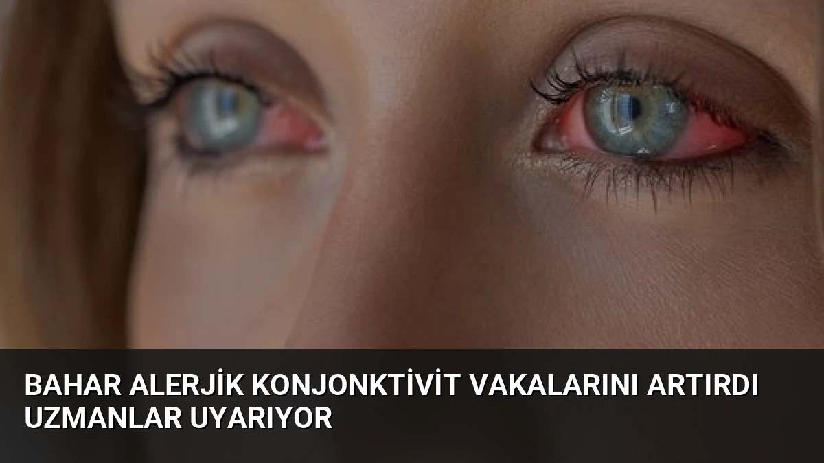 Bahar Alerjik Konjonktivit Vakalarını Artırdı Uzmanlar Uyarıyor
