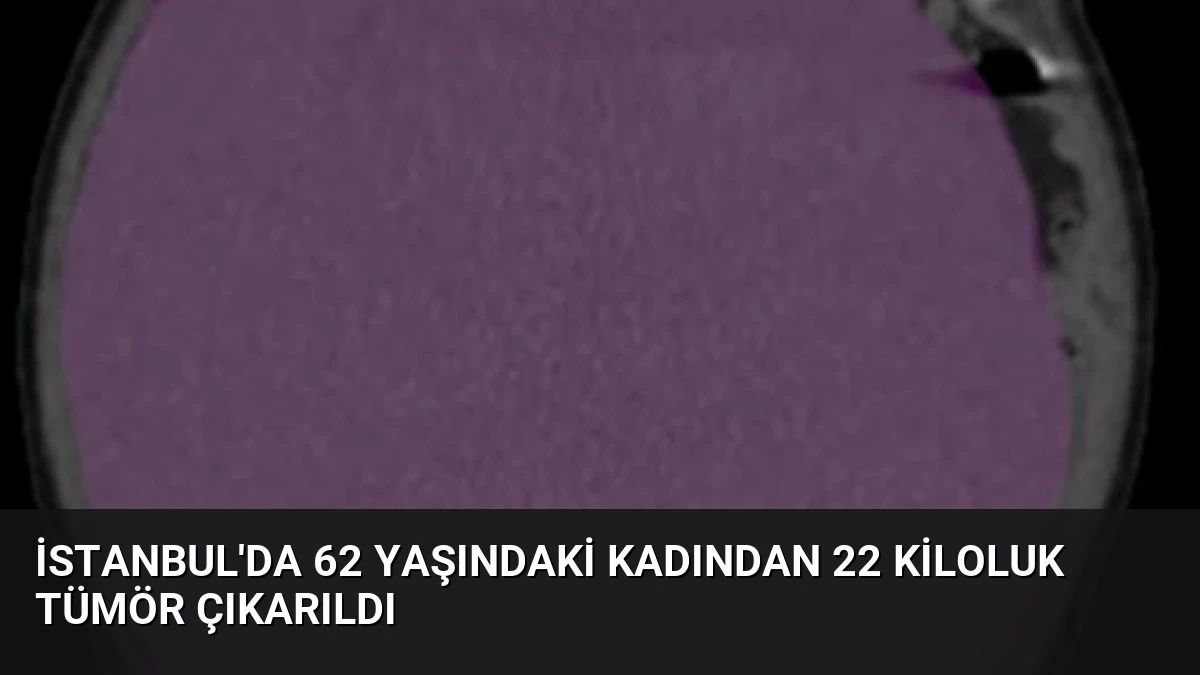 İstanbul’da 62 Yaşındaki Kadından 22 Kiloluk Tümör Çıkarıldı