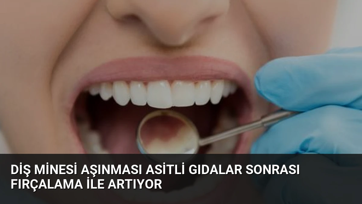 Diş Minesi Aşınması Asitli Gıdalar Sonrası Fırçalama ile Artıyor
