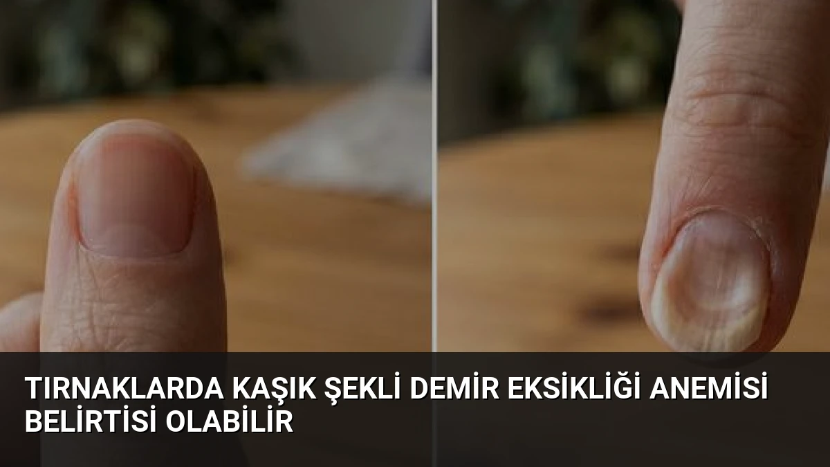 Tırnaklarda Kaşık Şekli Demir Eksikliği Anemisi Belirtisi Olabilir